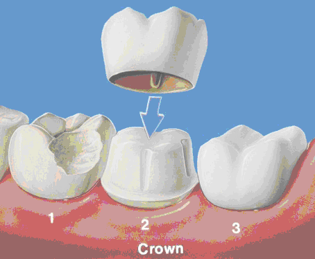 Porcelain crowns